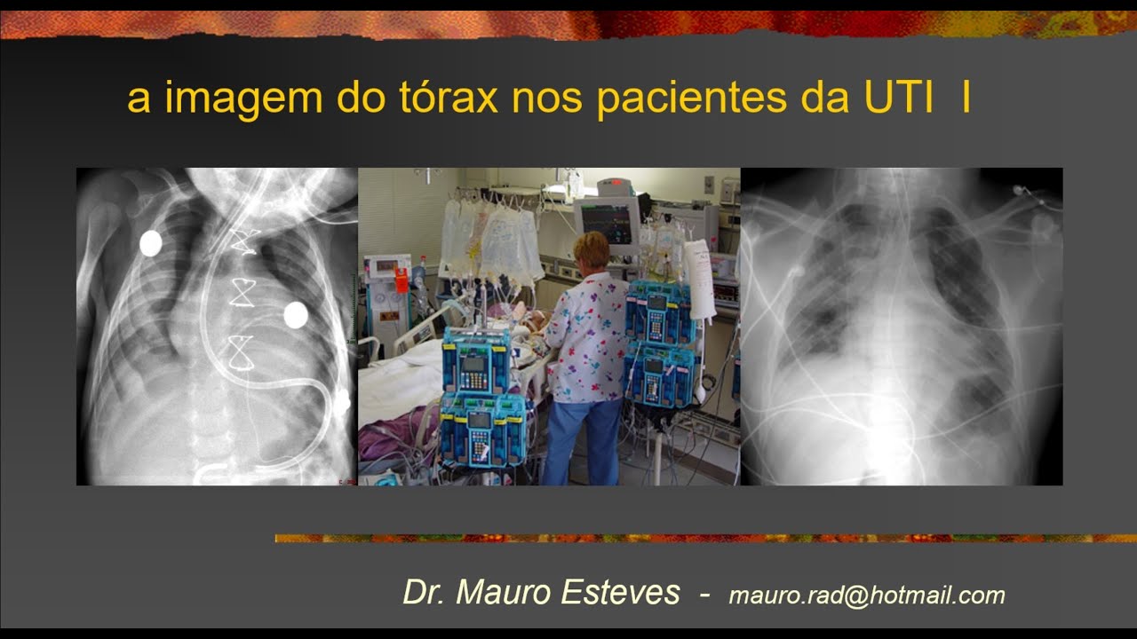 A imagem do tórax na UTI   I