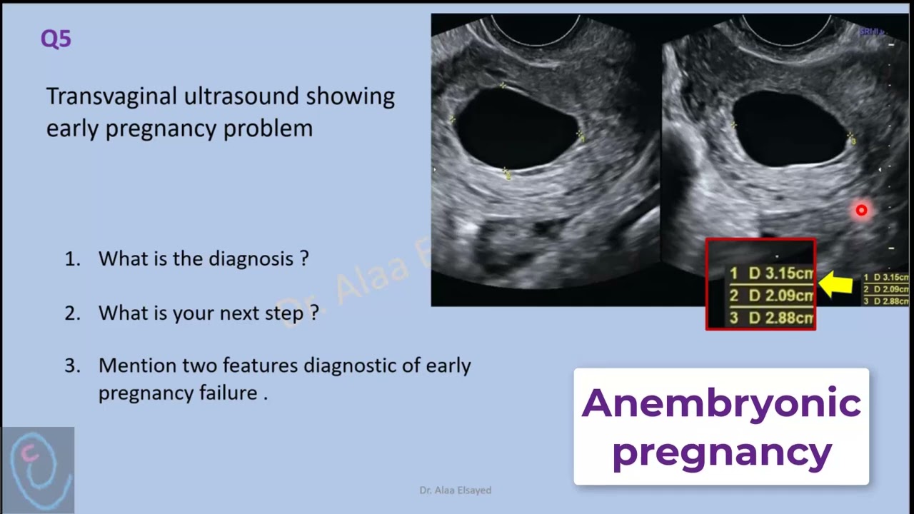 Slide 1  -  Anembryonic pregnancy
