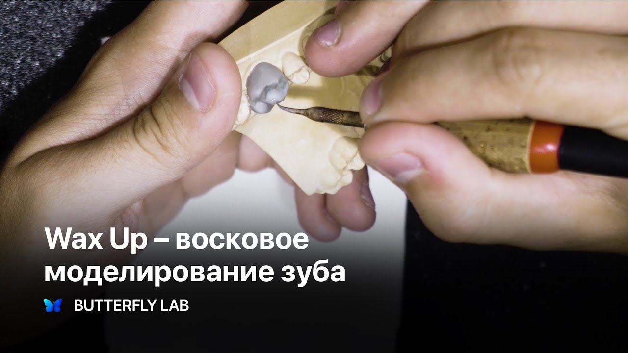 Wax Up Live. Восковое моделирование зуба. Зубной техник