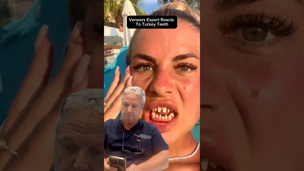 Veneers Expert Reacts To Turkey Teeth 👀🦷🇹🇷 #veneers #turkeyteeth #dentist #harleystreet
