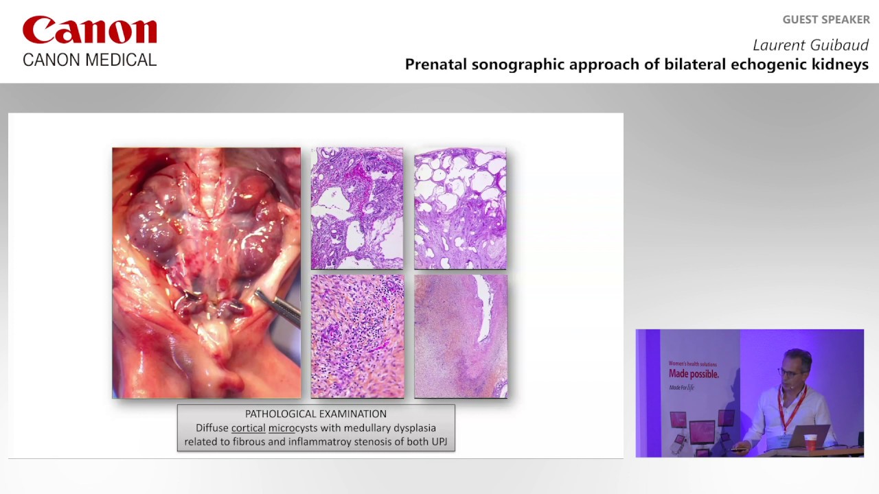 ISUOG 2019 - Laurent Guibaud on prenatal sonographic approach to echogenic kidneys