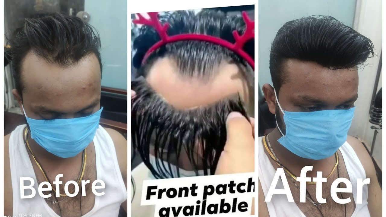 front hair line hair patch j&k 25 Laxmi Nagar Delhi metro station gate number 9654640224 only 6000