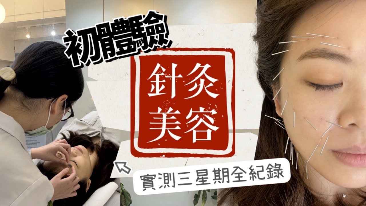 中醫針灸美顏針 真係Work? 實測三星期｜美容針 | 美顏針灸 | 瘦臉美容｜臉部針灸｜改善法令紋 面部鬆弛｜西營盤