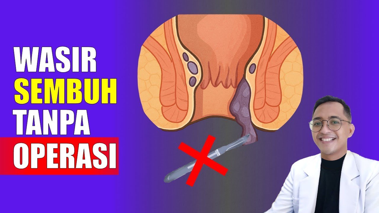 Cara Ampuh Mengatasi Wasir Tanpa Operasi! 100% Alami & Aman