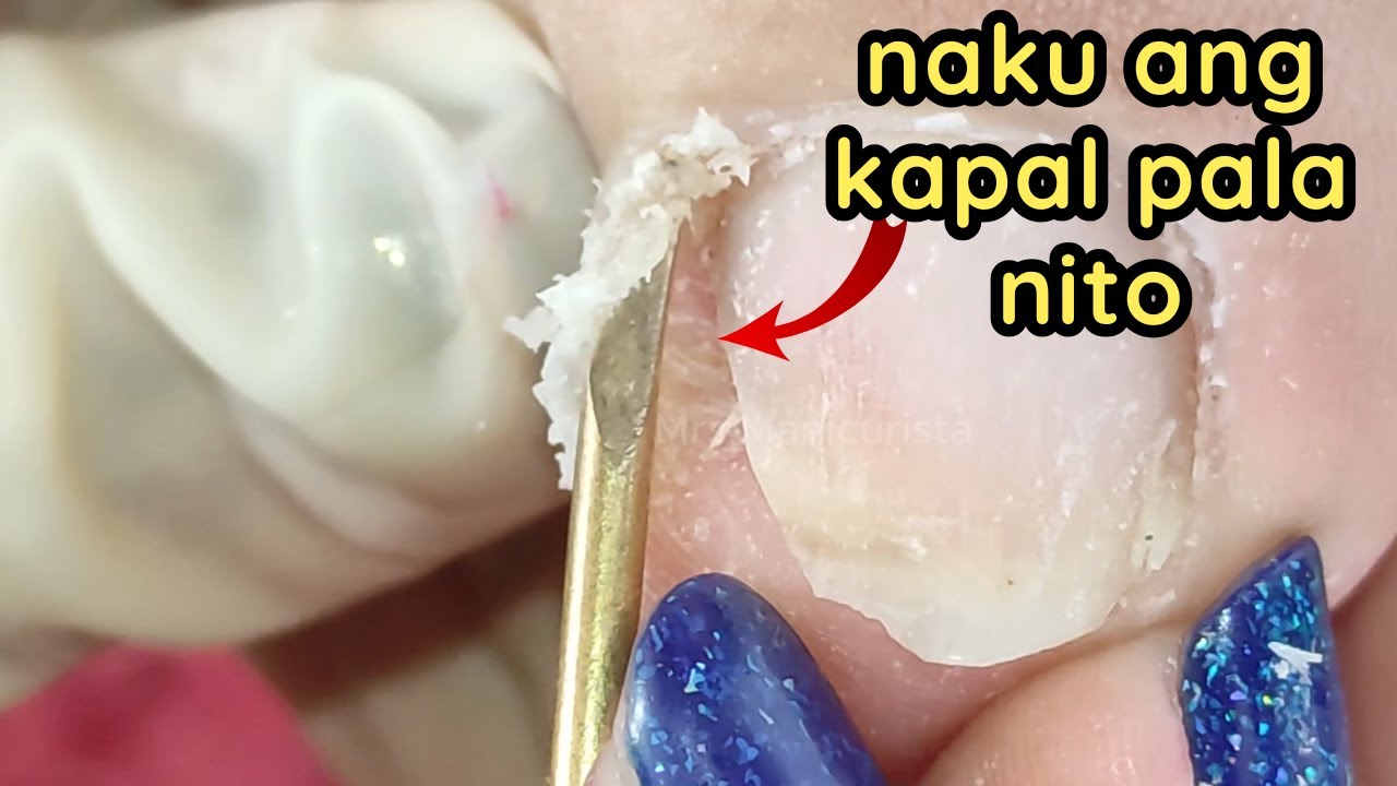 Makapal na madaming dry skin sa paa