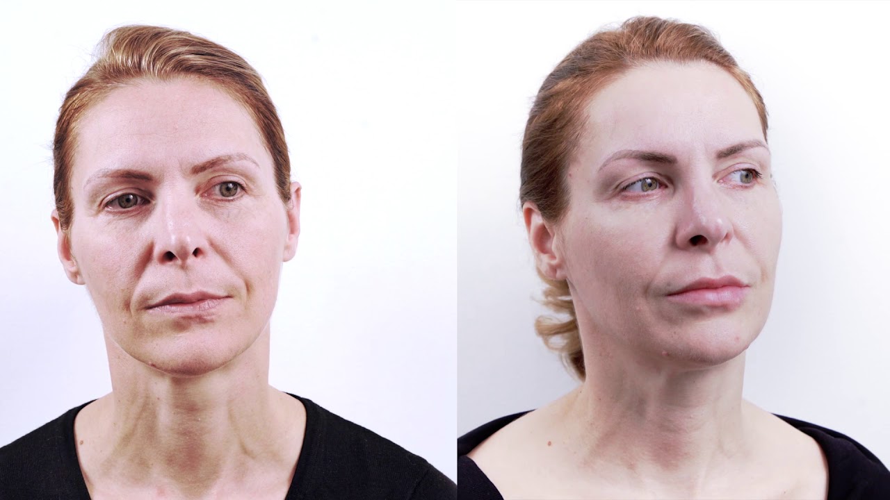 BOTOX AND FILLERS: Fantastic makeover!