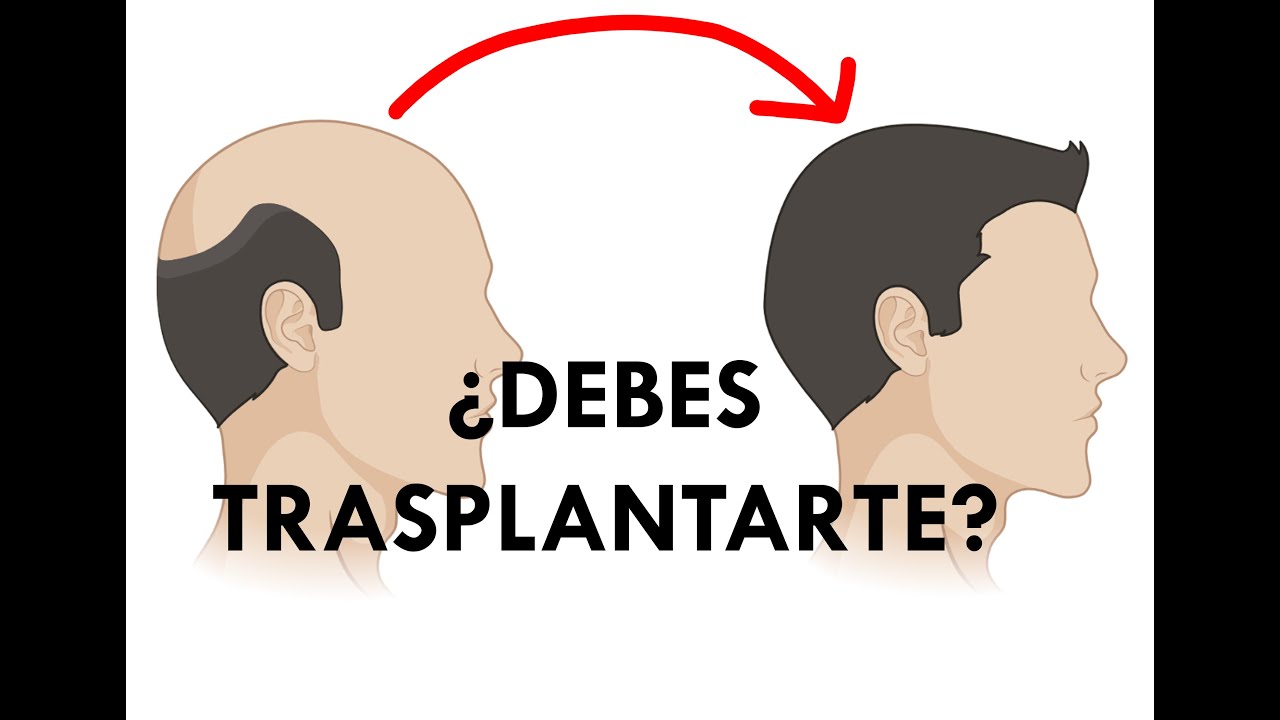 DERMATÓLOGO TE EXPLICA SI DEBES TRASPLANTARTE PELO
