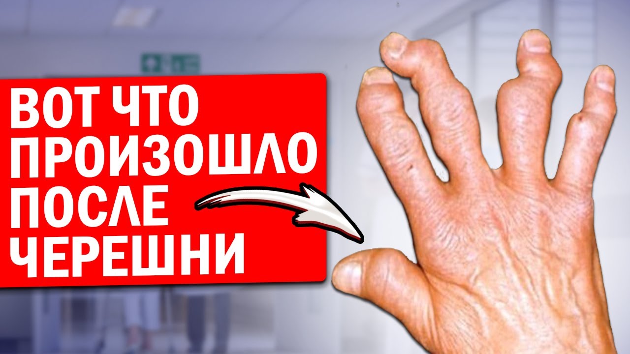 Ем черешню каждый день: вот что натворила черешня с суставами, подагрой, сосудами, мозгом и даже...