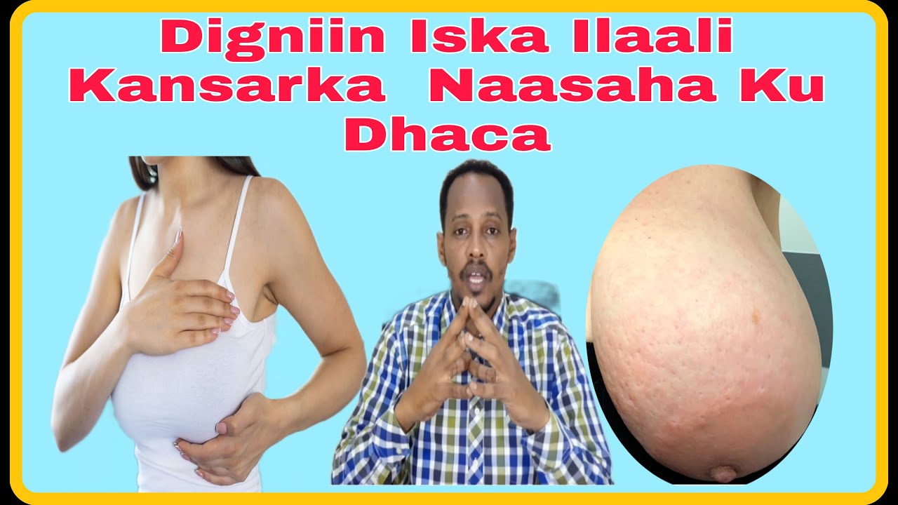 Kansarka Nasaha Dumarka Ku Dhaca ( Breast Cancer) Waxyabaha Kena Sameynta Caafimaad Daro Ka Dhalata