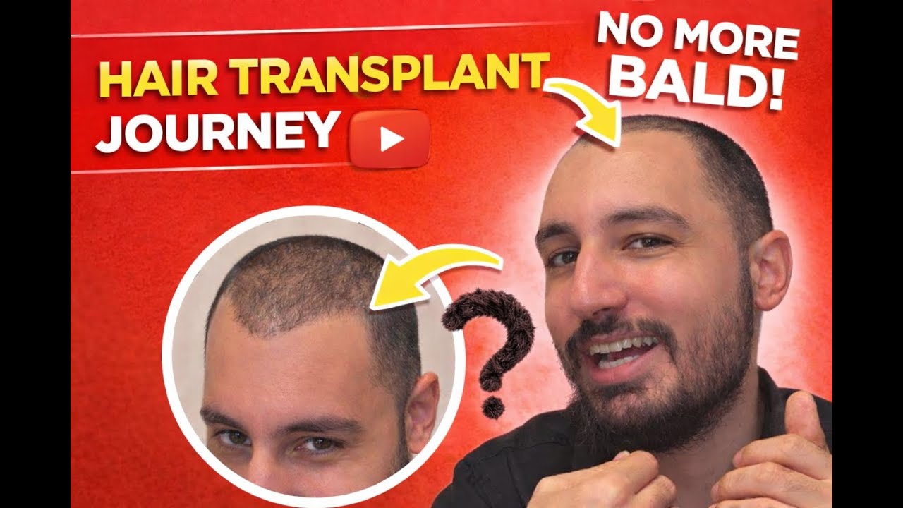 Why I’m Sharing My Hair Transplant Journey