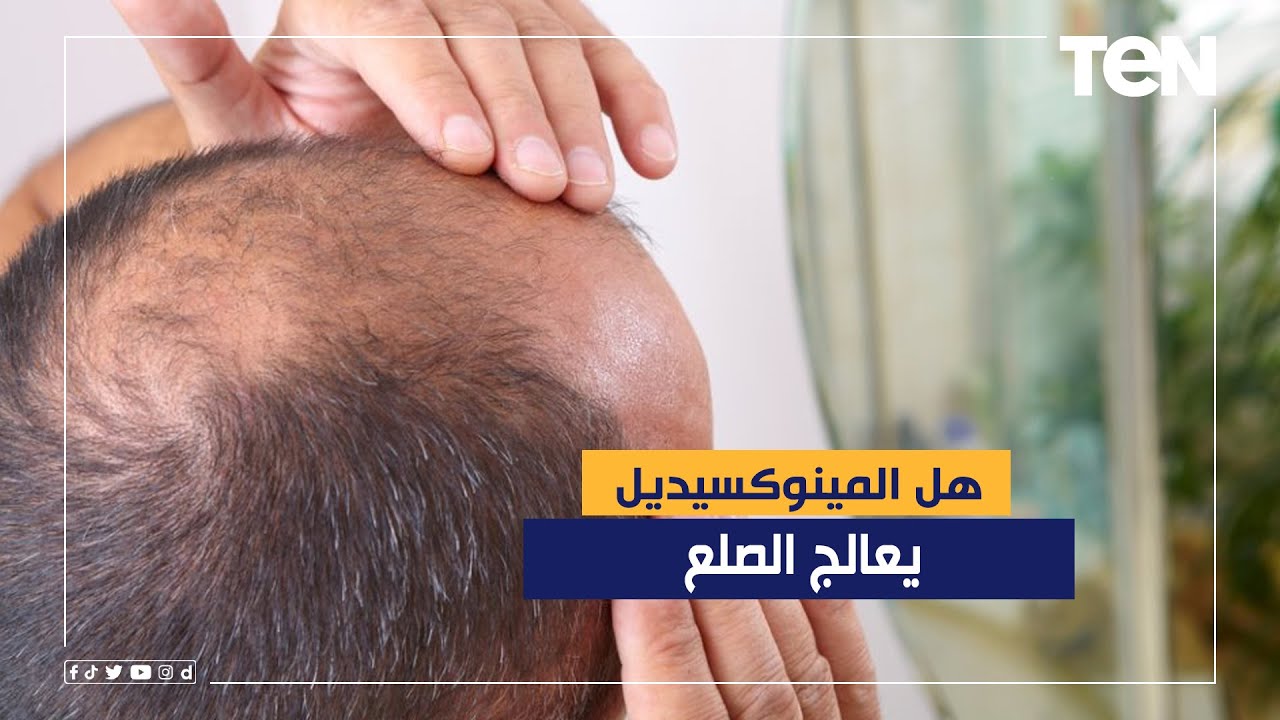 يسبب الهبوط  .. الدكتور هاني الناظر يحذر من المينوكسيديل لعلاج الصلع