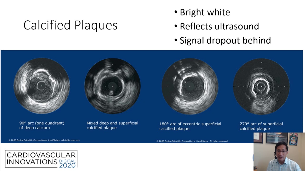 IVUS guided PCI: step-by-step_Seto_Coronary On Demand