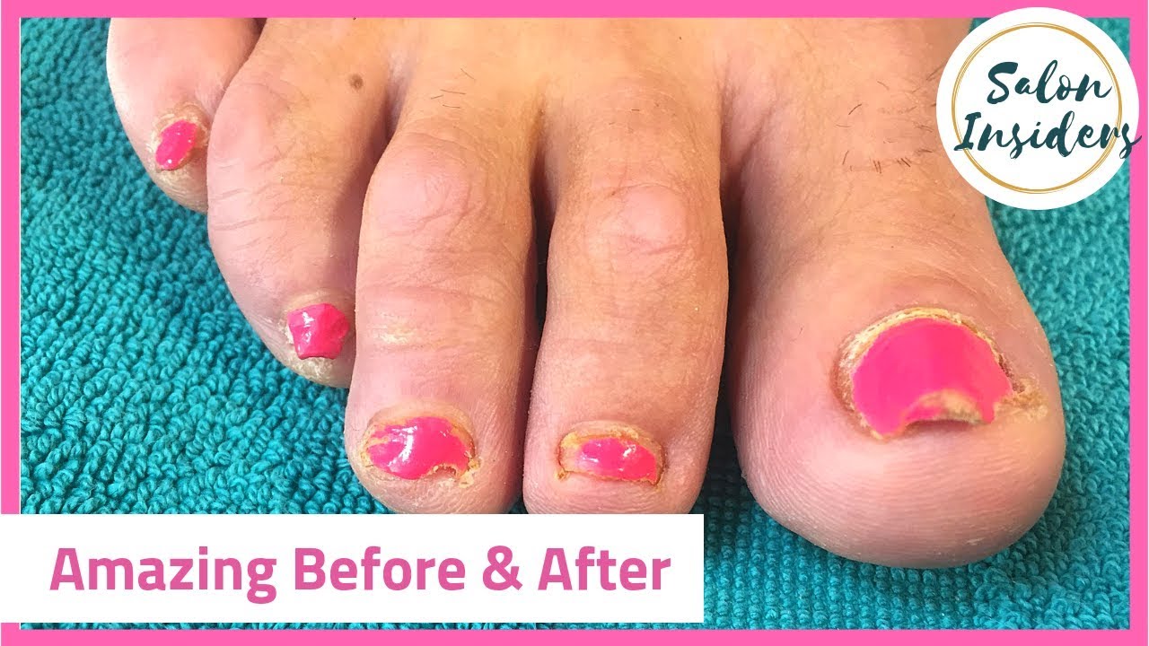Pedicure Tutorial: Toe Nail Reconstruction