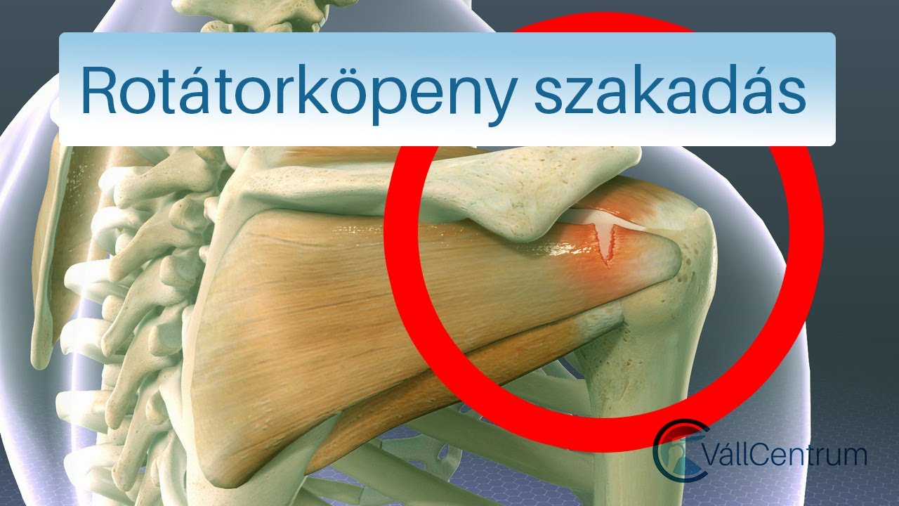 Nagyméretű rotátorköpeny szakadás - Dr. Gulyás Károly vállsebész