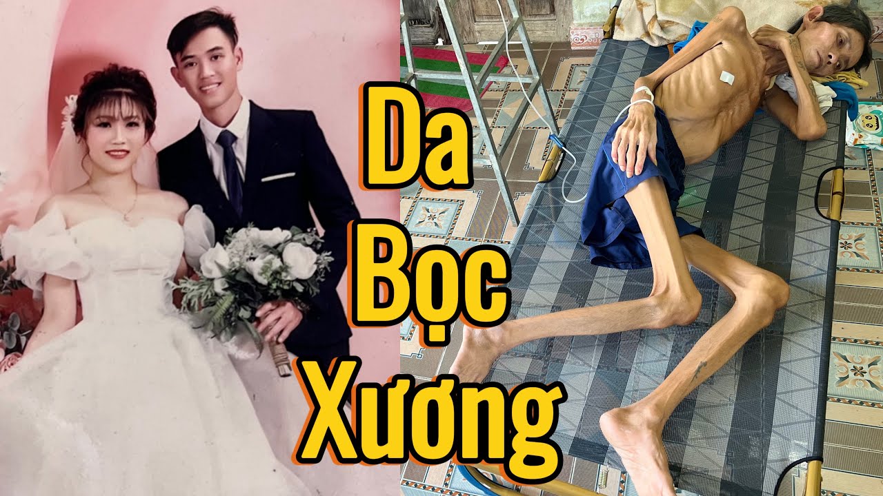 Người đàn ông sụt 20kg trong 10 ngày chỉ còn da bọc xương 