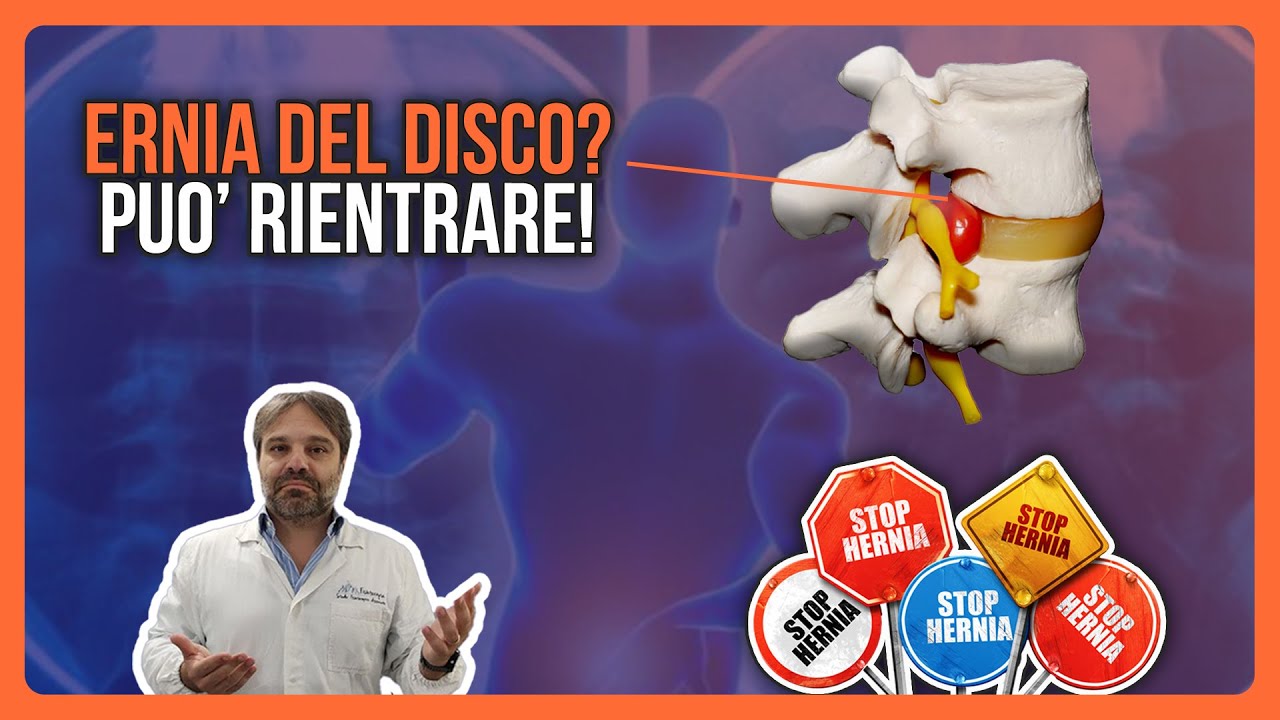 ERNIA DEL DISCO: PUO' RIENTRARE ! Sono SCIOCCATO!!😬😬