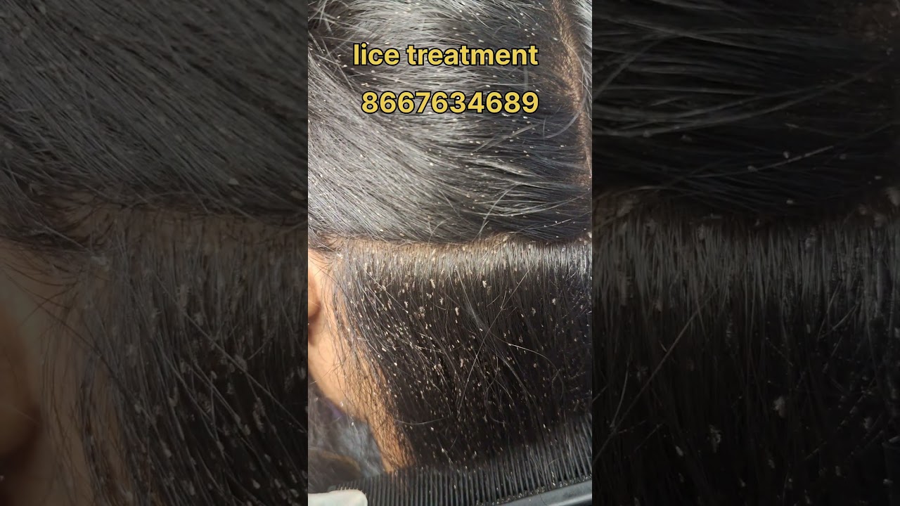 How to remove nits and lice treatment #lice #nits #headlice #coimbatore  #liceremoval #peenu #eeru