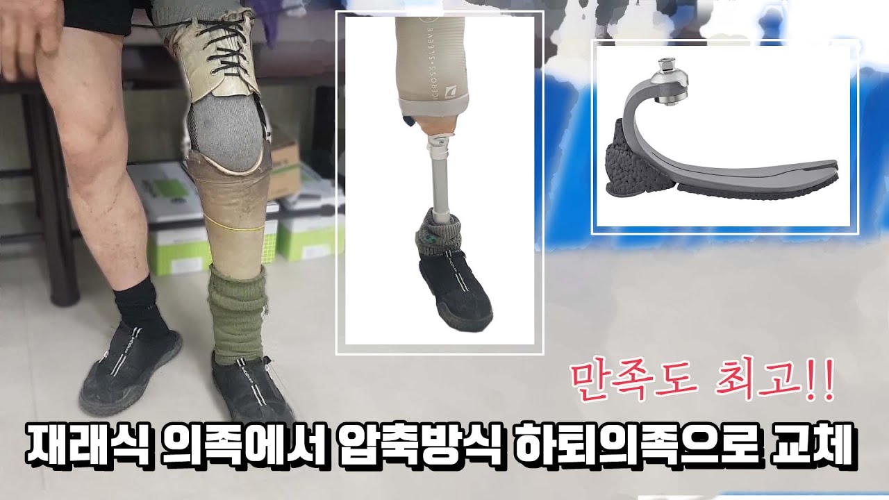 재래식 의족에서 압축방식 하퇴의족으로 교체 후 변화