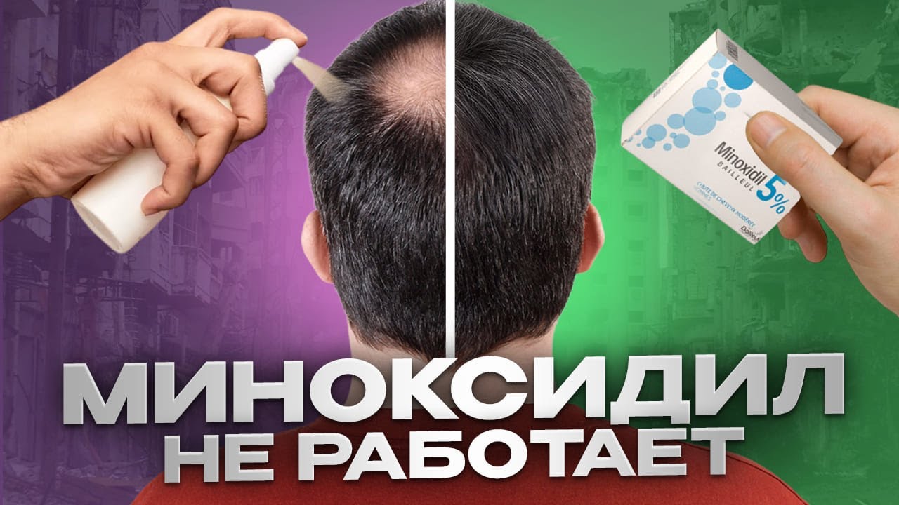 КАКАЯ ФОРМА МИНОКСИДИЛА РАБОТАЕТ?