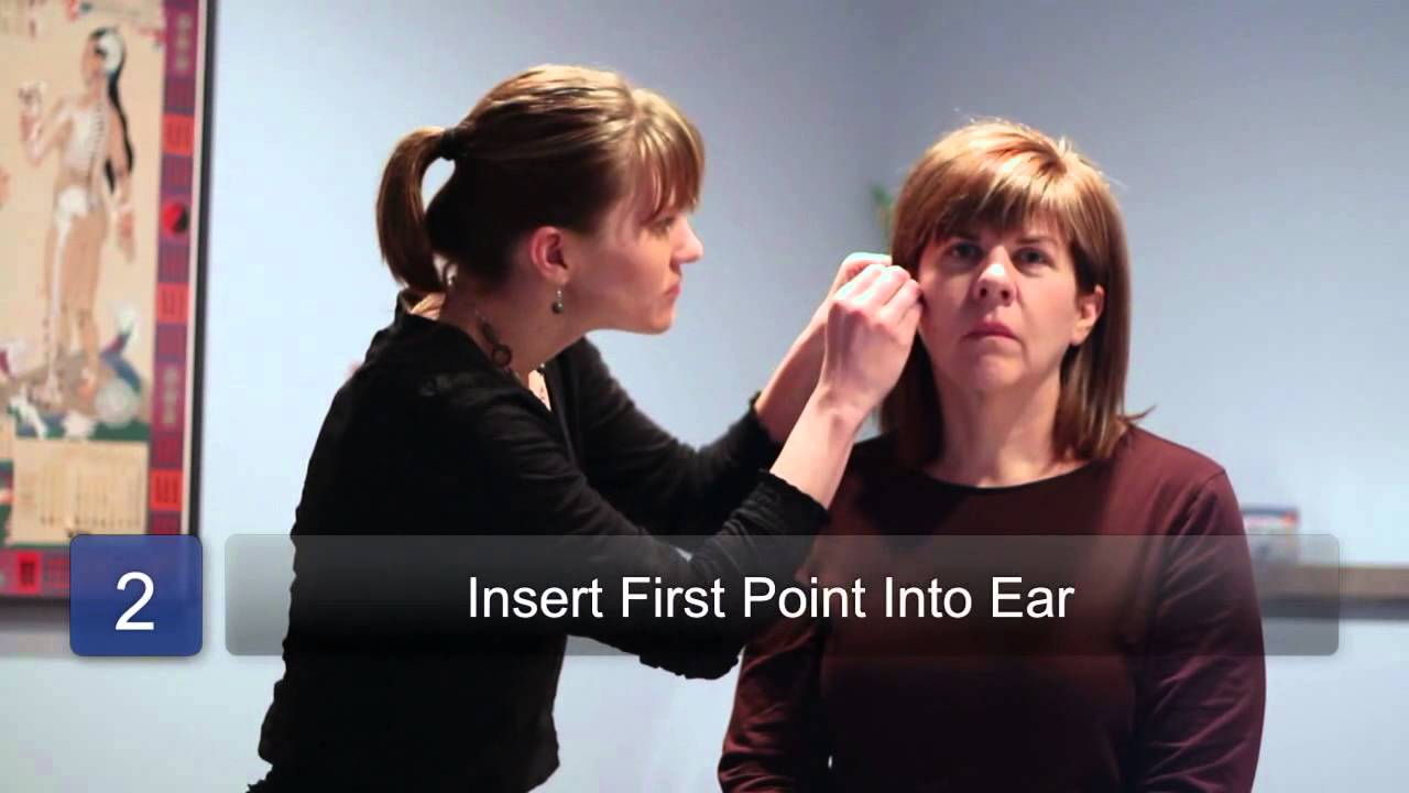 Ear Acupuncture to Lose Weight