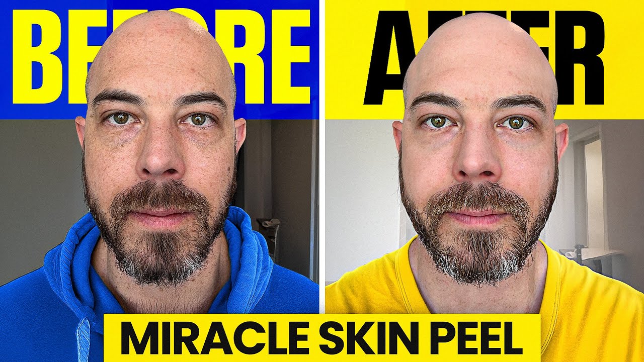 At-Home Chemical Peel That Actually Works! | Dermatologist Review