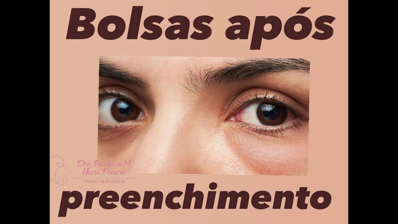Bolsas embaixo dos olhos após preenchimentos: conheça as possíveis causas