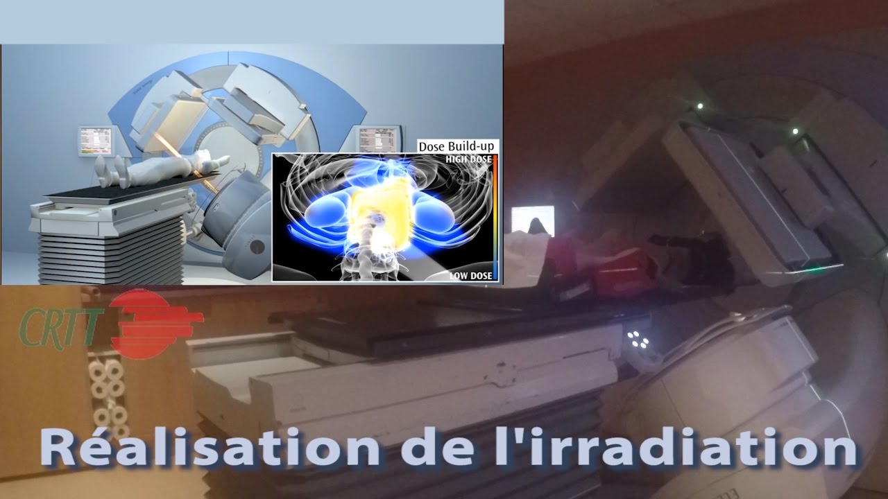 réalisation d'une séance de radiothérapie en modulation d'intensité rotationnelle au CRTT de Versail