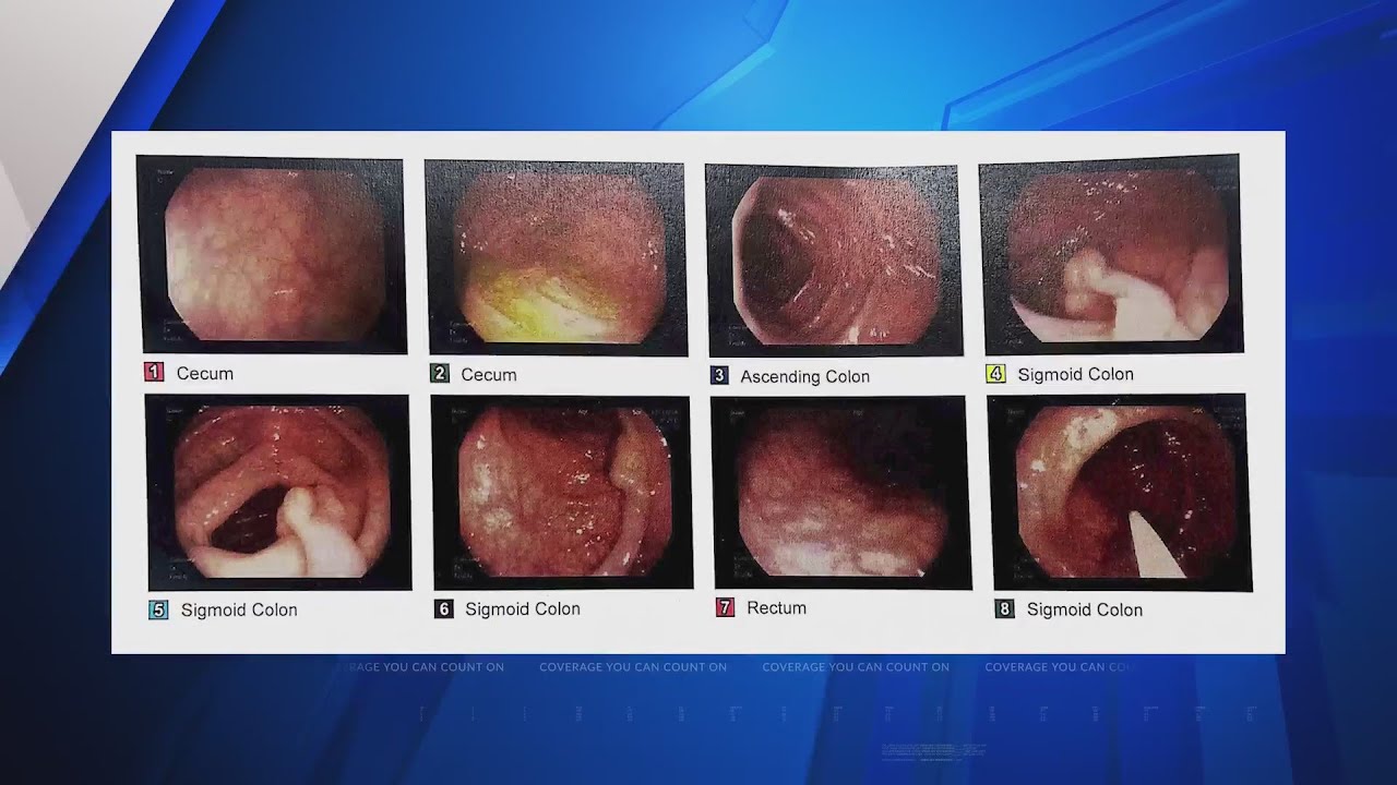 SSM Health Medical Minute &ndash; 'Almost all deaths from colon cancer can be prevented'