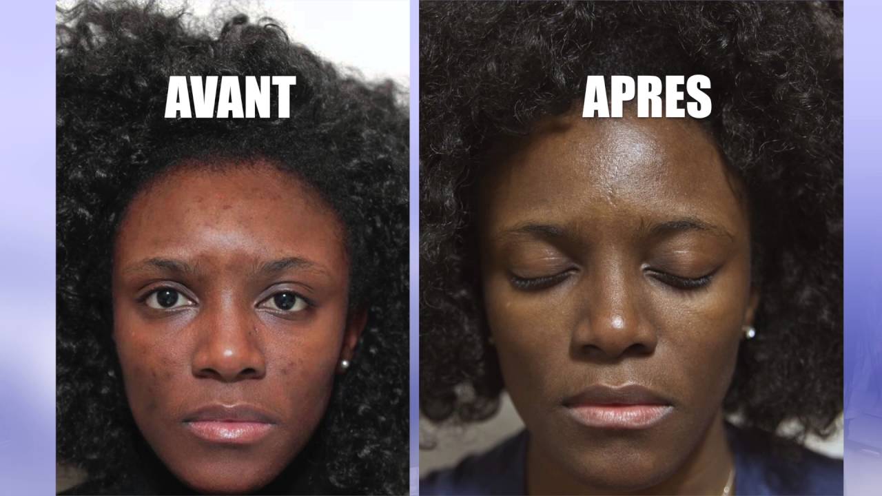 Comment éliminer les taches sur la peau. par DR OHEMBA WANDJE (Paris)