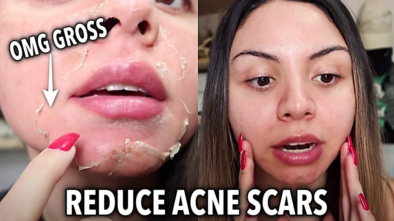 Chemical Peel Before and After Vlog 2 | Full Process + Results | VI peel