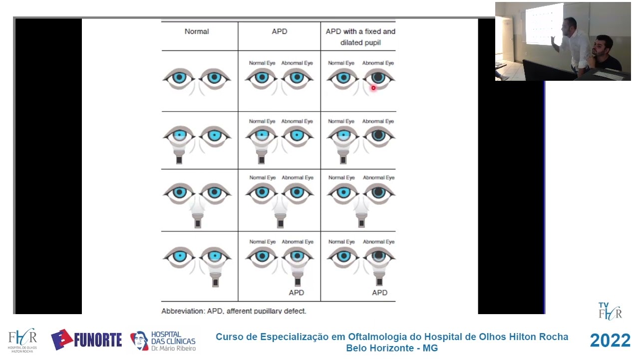 Semiologia Pupilar e Alterações Pupilares_Dr  Filipe Fernandes e Dr  Francisco Caetano