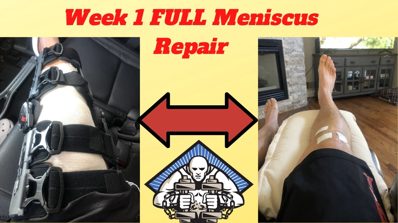 Week 1 after Full Meniscus Repair 💪