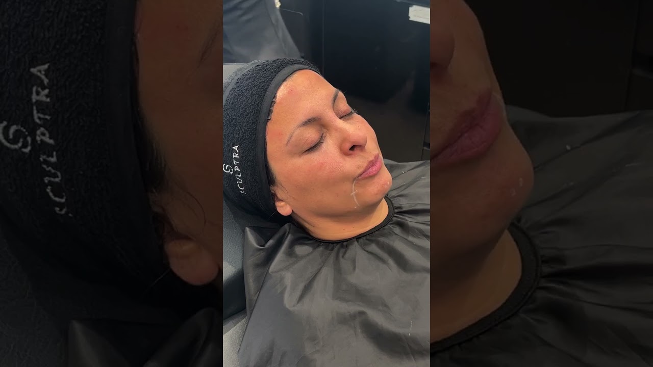 Botox Full face ( REALIFT BLACK)