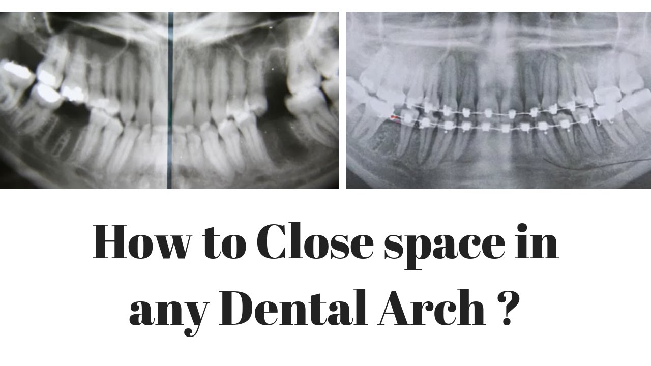 How to Close space in any Dental Arch ?