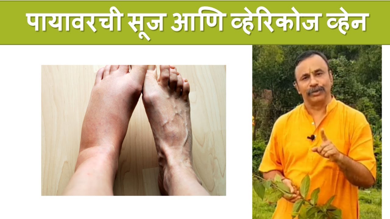 पायावरची सूज आणि व्हेरिकोज व्हेन / दामले उवाच भाग १८५ / Remedy for Varicose Vein
