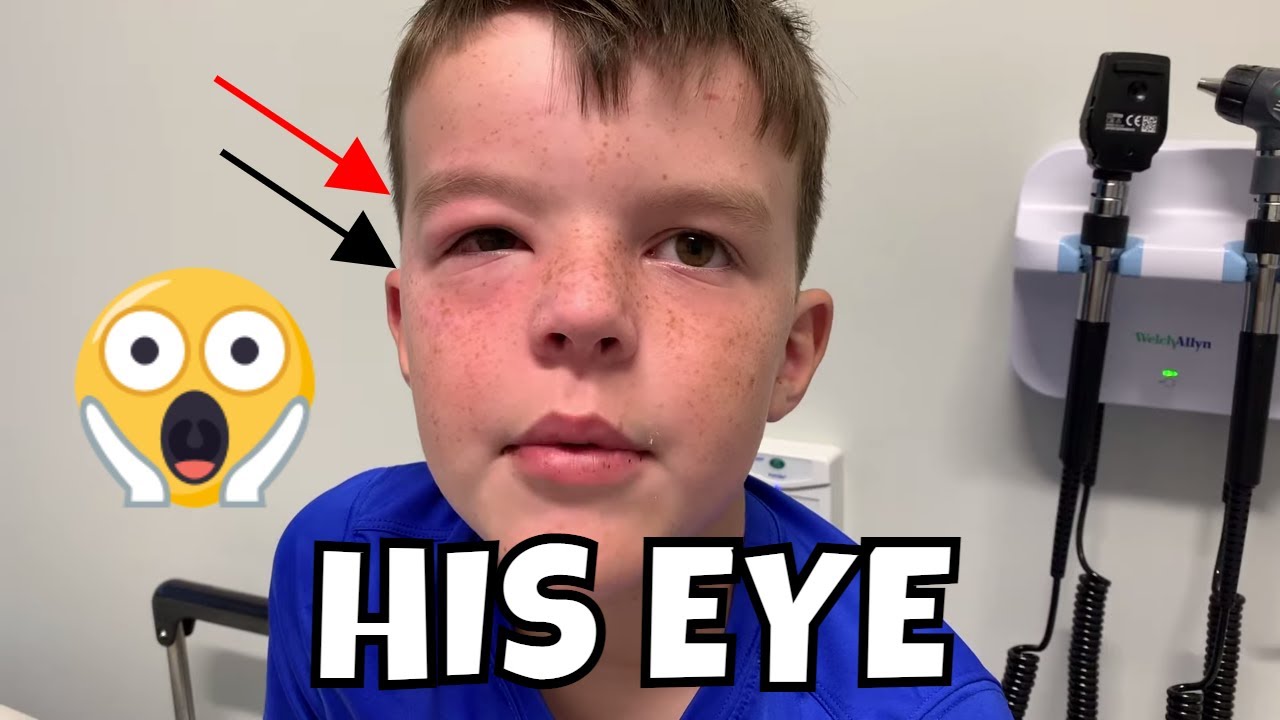 HIDDEN ALLERGY OUTBREAK FOR OWEN!