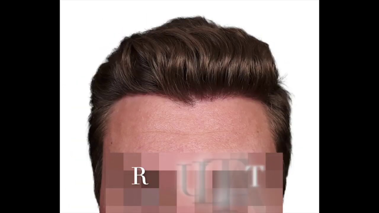 Haartransplantation Geheimratsecken Dense Packing Dr. Heitmann Schweiz