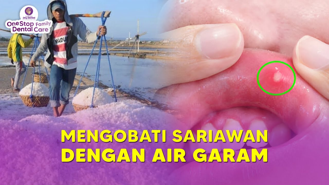 APAKAH BISA MENGOBATI SARIAWAN DENGAN AIR GARAM ?