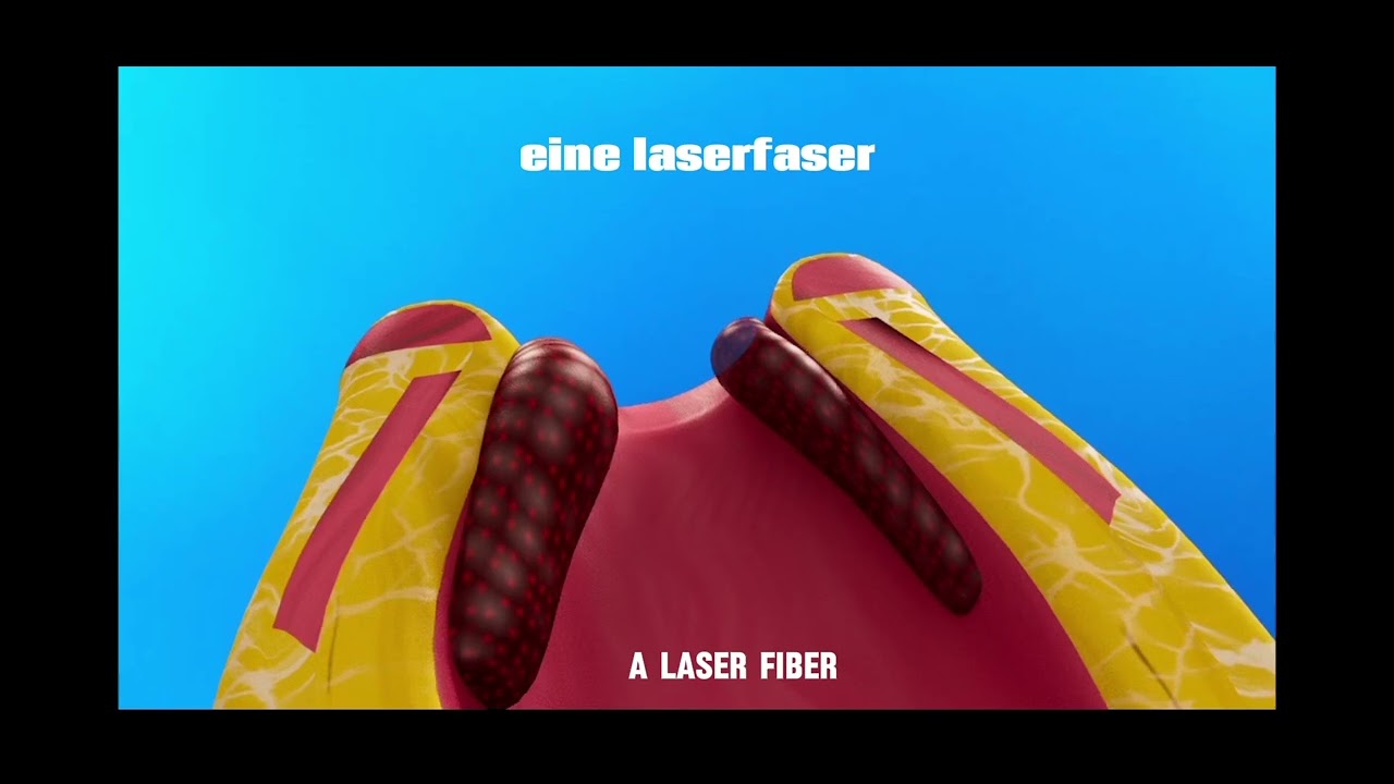 Laserbehandlung von Haemorrhoiden