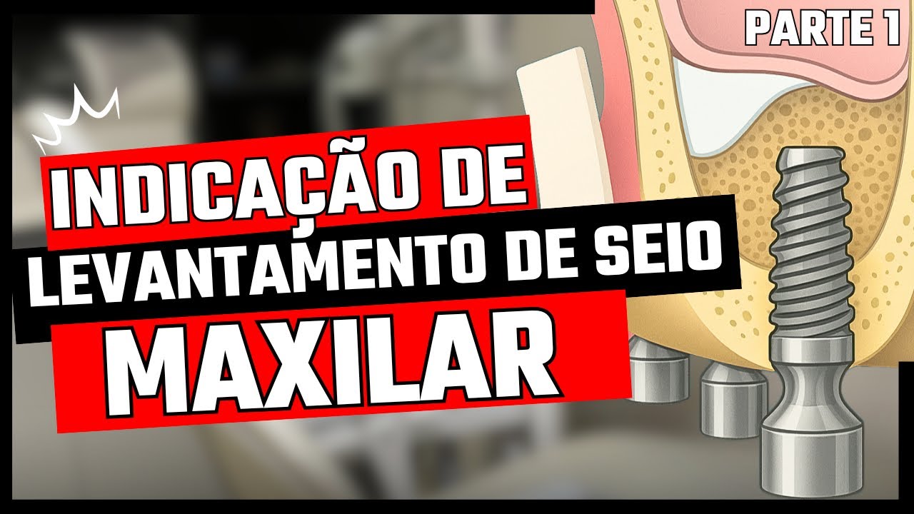 Quando é necessário fazer o levantamento de seio maxilar? | Parte 1