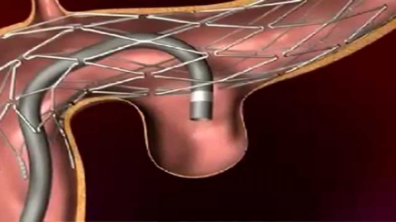 Endovascular Coiling for Brain Aneurysm