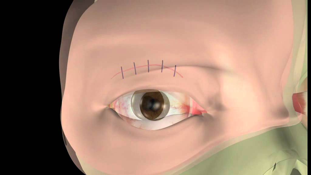 Thyroid eye disease - 14. Lid surgery - The operation