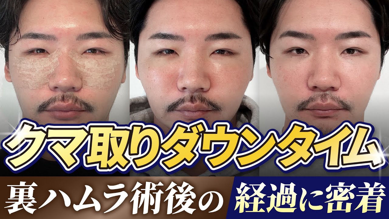 【裏ハムラ】30代男性クマ取りダウンタイムを毎日レポート！術式改良で腫れが少なくなった？その理由とは。【目の下のクマ】
