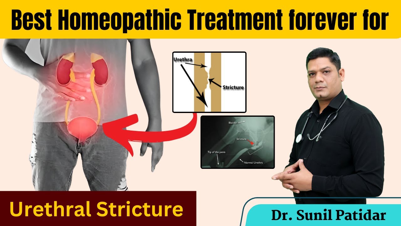 Best Homeopathic Treatment Forever for Urethral Stricture | Sunil Patidar #urethra