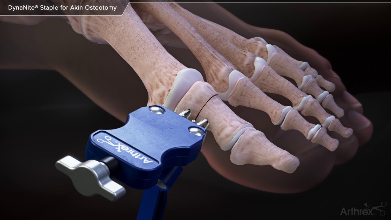 DynaNite® Staple for Akin Osteotomy