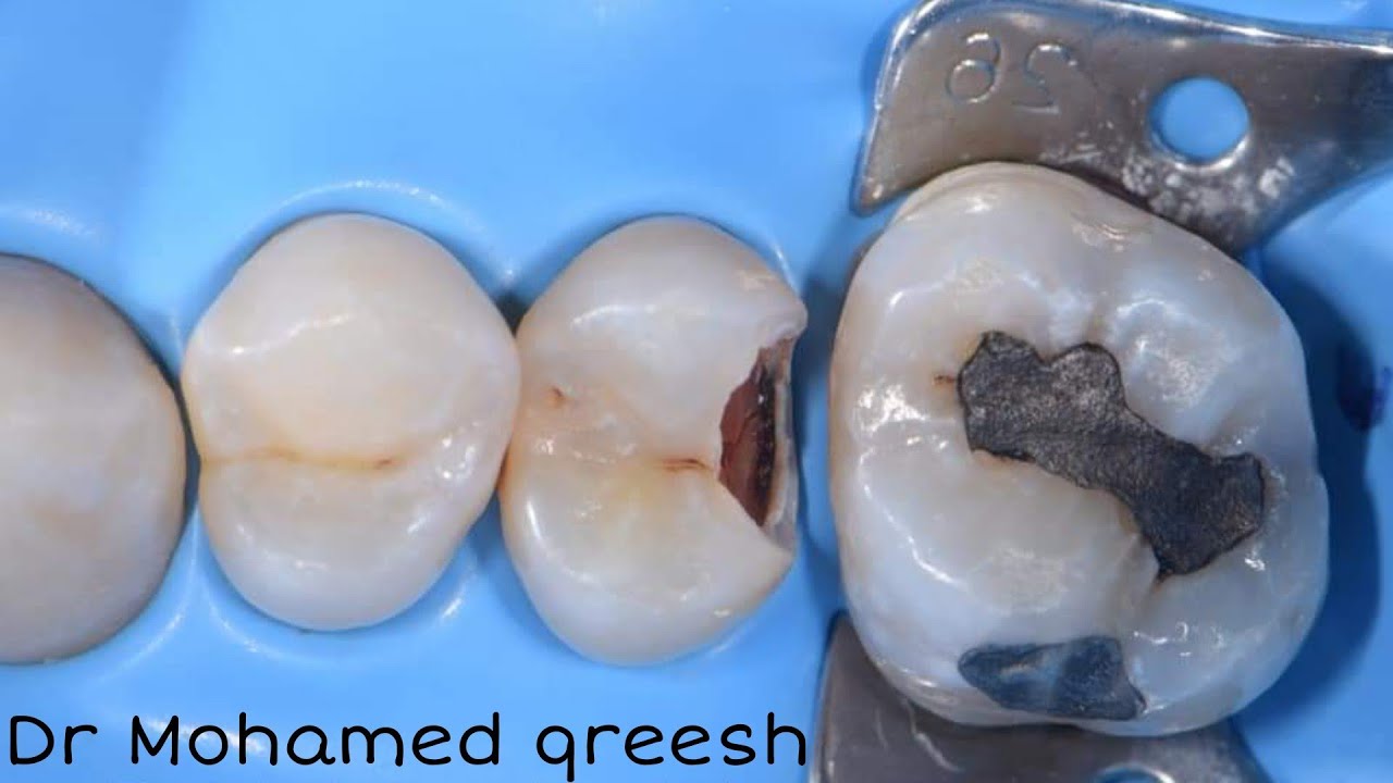 Rubber Dam Isolation for posterior teeth || multiple Isolation technique