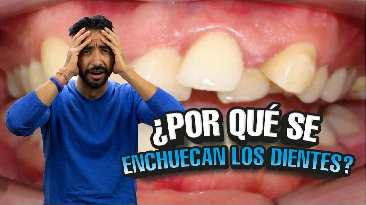 Por qué se enchuecan tus dientes después de tener brackets I Tu Dentista de Confianza