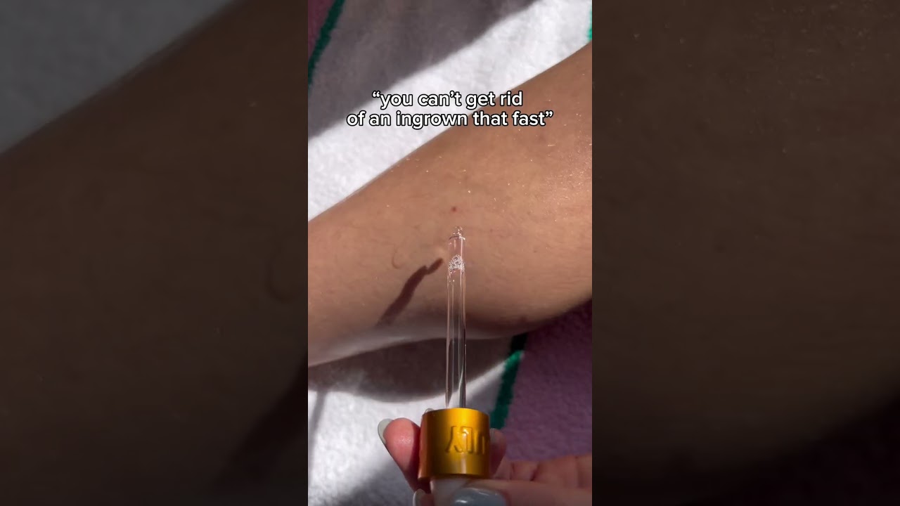 THE BEST INGROWN TREATMENT 