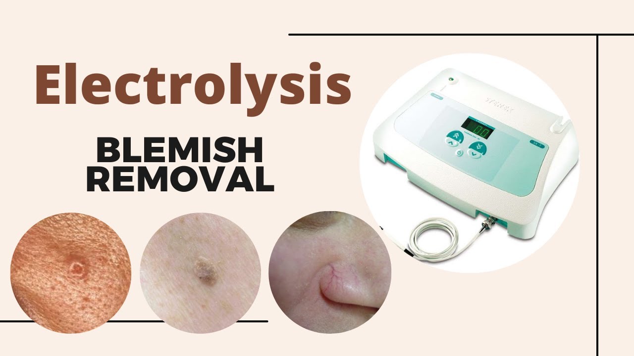 Advanced Electrolysis to remove thread veins, milia, skin tags, cherry angiomas, moles and more
