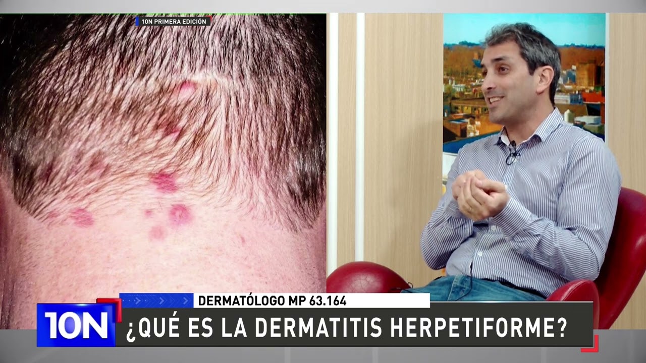 &iquest;Qu&eacute; es la dermatitis herpetiforme?